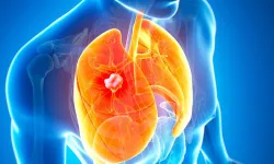 Akciğer kanserinin en erken evresini saptayabilen kan testi geliştirildi