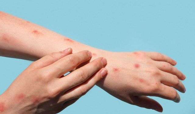 KTTB'den maymun çiçeği hastalığı üzerine interaktif zoom toplantısı