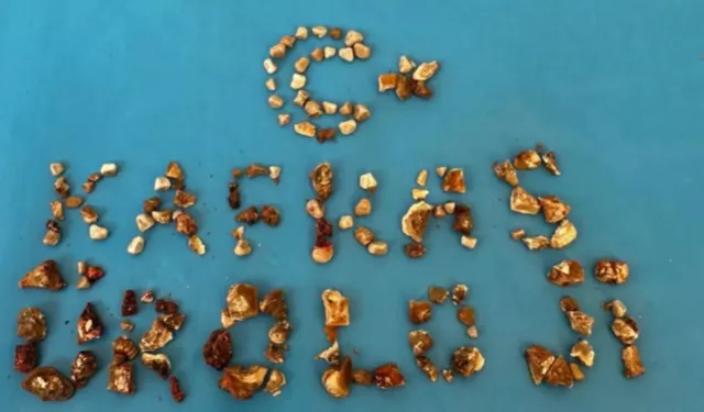 Doktorları şaşırtan nadir vaka: Bir hastanın böbreklerinden 300'e yakın taş çıkarıldı